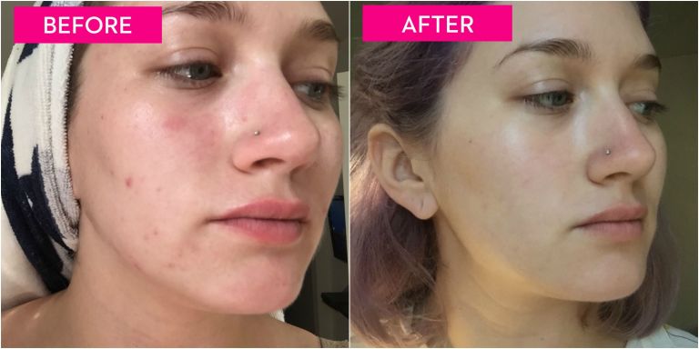 Image result for BEFORE AFTER PIMPLES