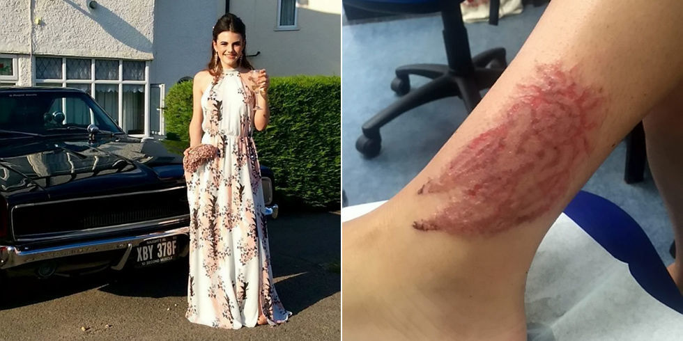 black henna tattoo leaves teen with burn scar dangerous black black henna tattoo leaves teen with burn scar dangerous black