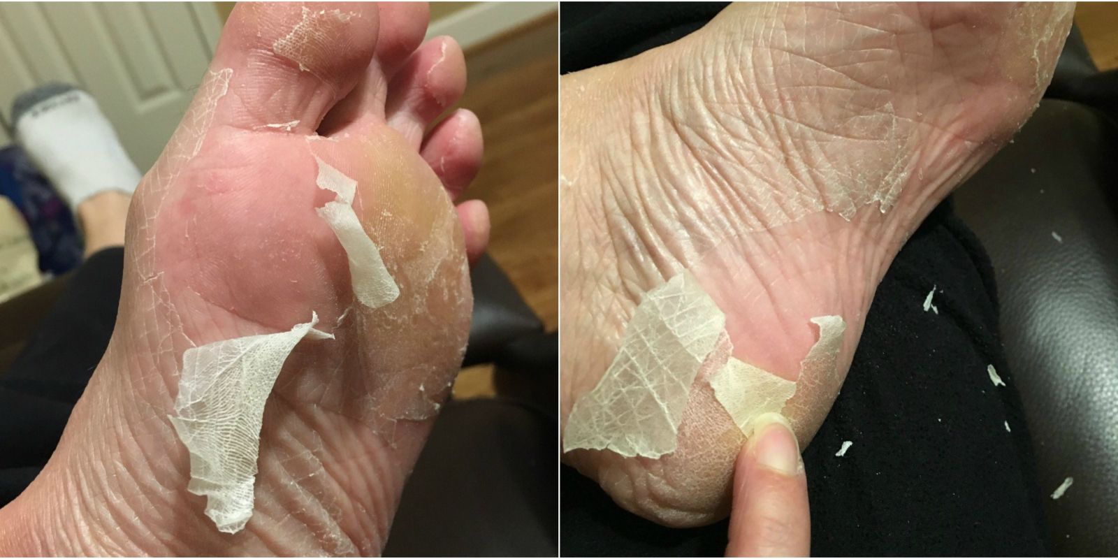 Dry Flaky Skin On Bottom Of Feet