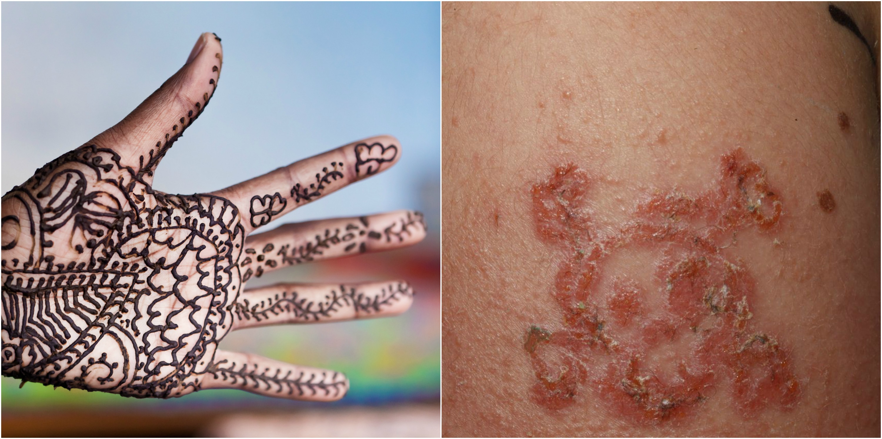 10YearOld Boy Suffers Allergic Reaction to Black Henna