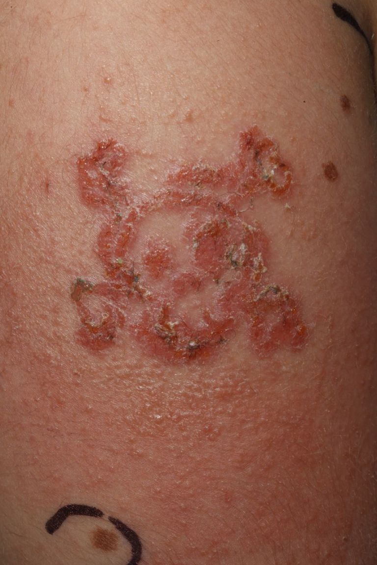 10 year old boy suffers allergic reaction to black henna tattoo 10 year old boy suffers allergic reaction to black henna tattoo