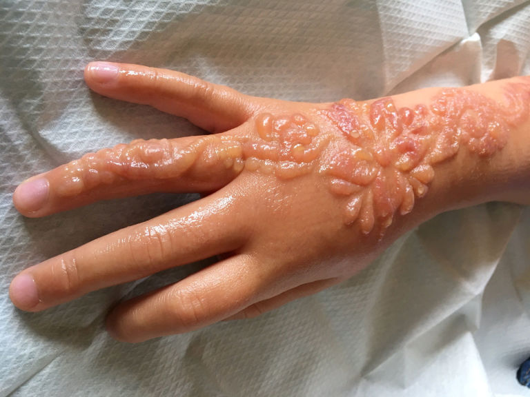 black henna tattoo causes chemical burns on little who may be black henna tattoo causes chemical burns on little who may be